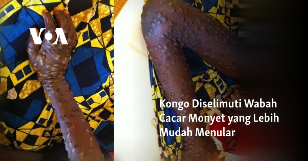 Kongo Diselimuti Wabah Cacar Monyet yang Lebih Mudah Menular